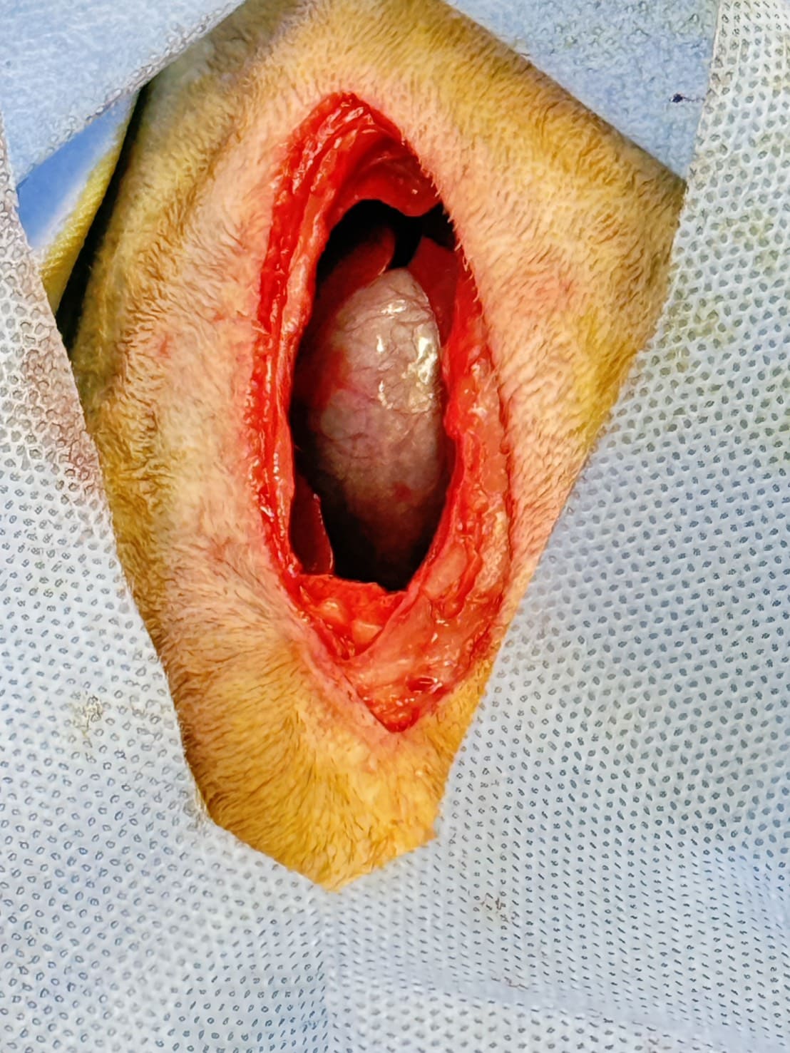 胆嚢炎により胆嚢切除を行った一例